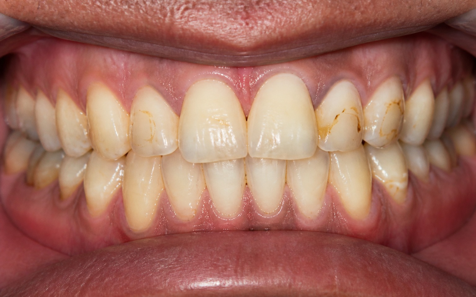 Before treatment